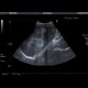 Liver hemangioma, huge: US - Ultrasound